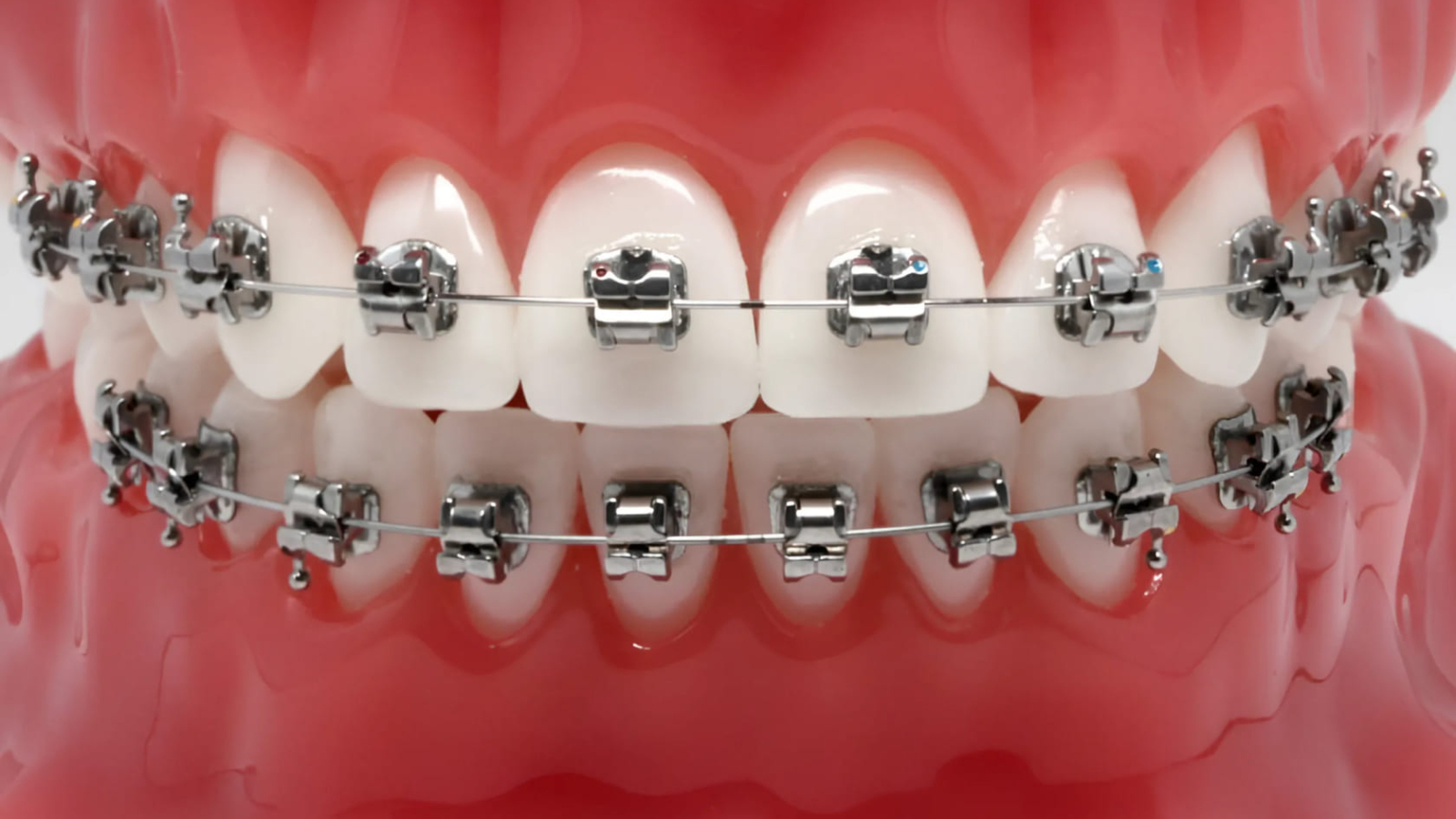 3oh9sw-2025-07-30protivopokazaniya-breket-sistem