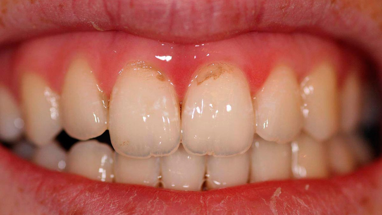 prisheechniy-karies-foto-kak-lechit-prichiny-vozniknoveniya